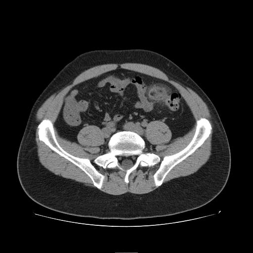 CT Abdomen 