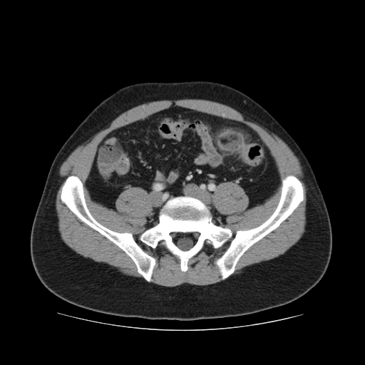 CT Abdomen