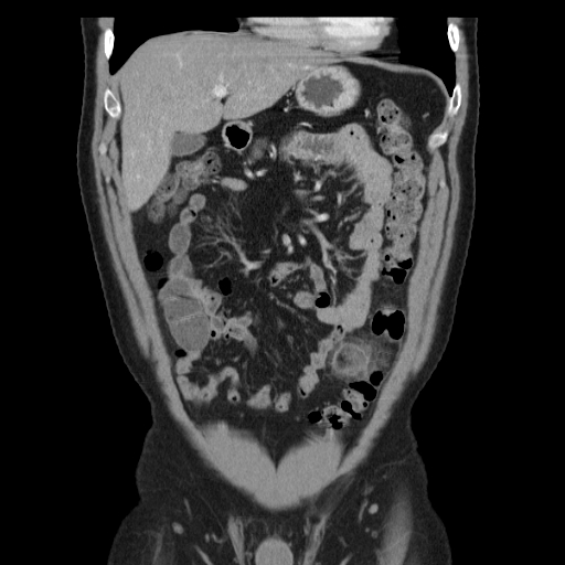 Ct Abdomen cor