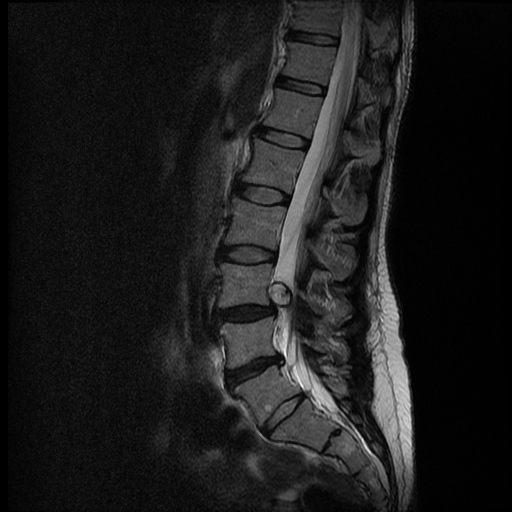 MRT T2w sagittal LWS