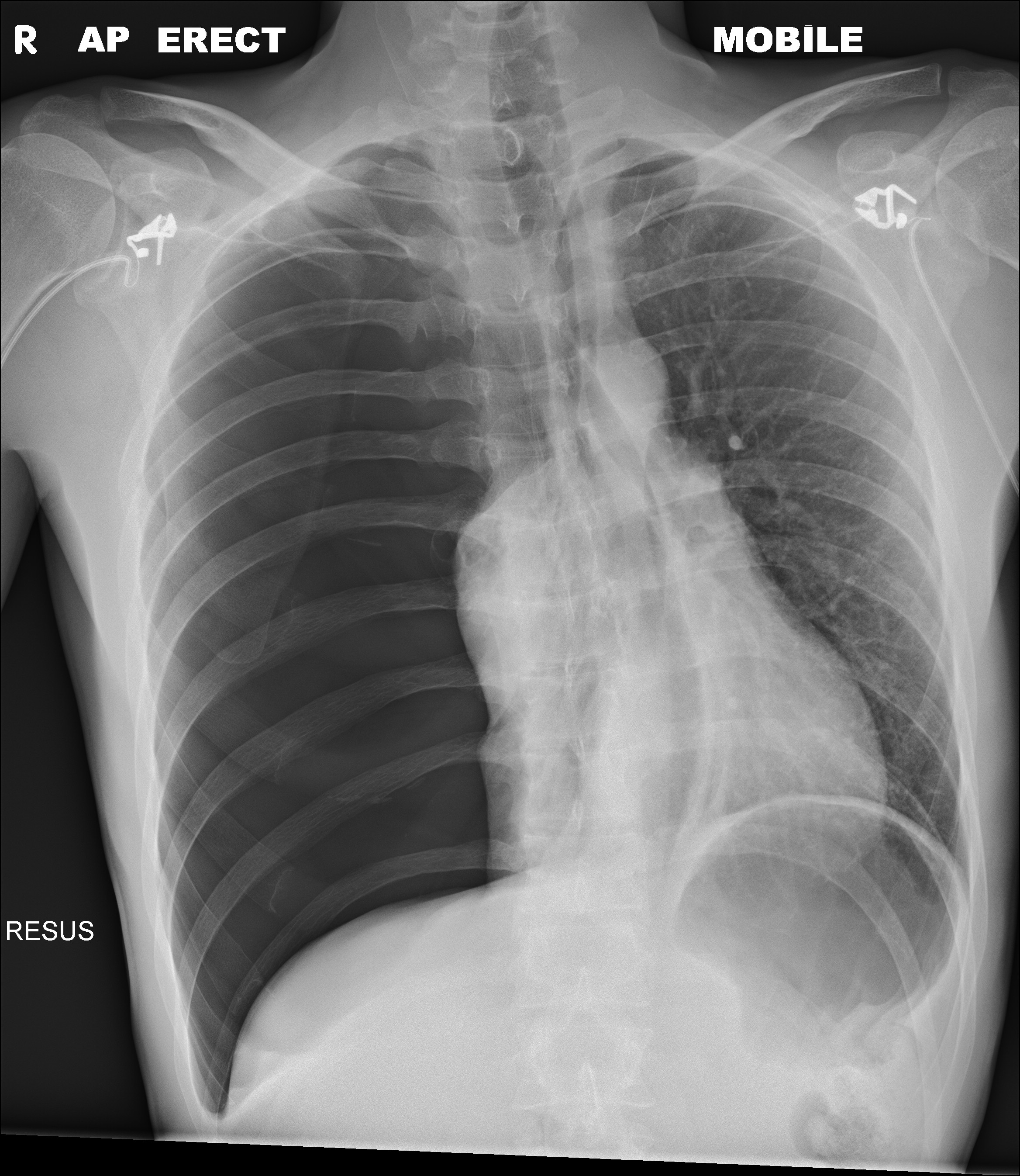 Röntgen Thorax