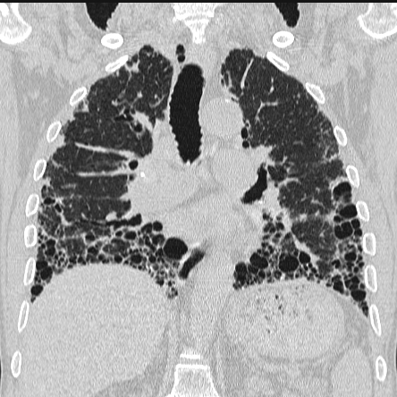 CT Thorax Lungenfenster koronar