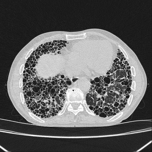 CT Thorax Lungenfenster transversal