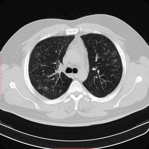CT Thorax Lungenfenster transversal