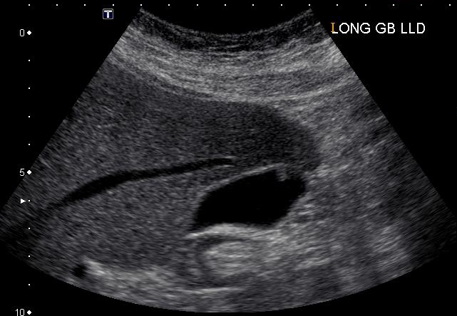 Sonographie Leber