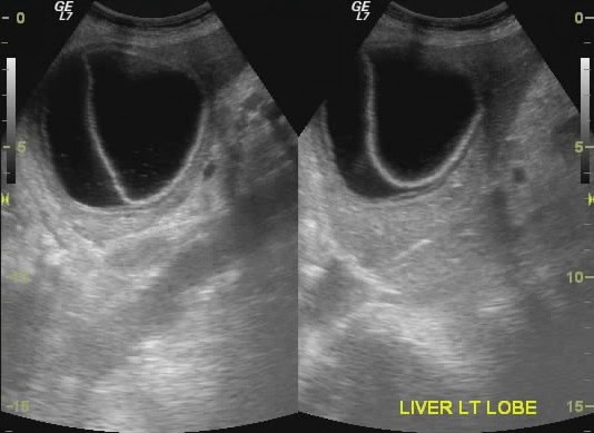 Sonographie Leber