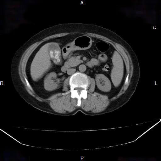 CT Abdomen nativ, axial