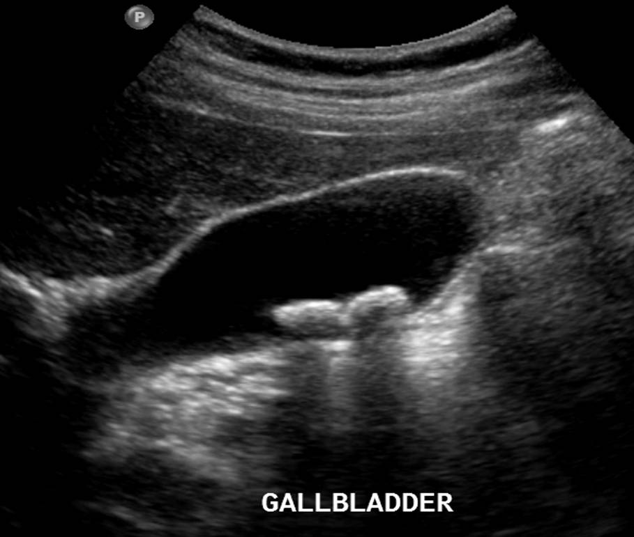 Sonographie Abdomen