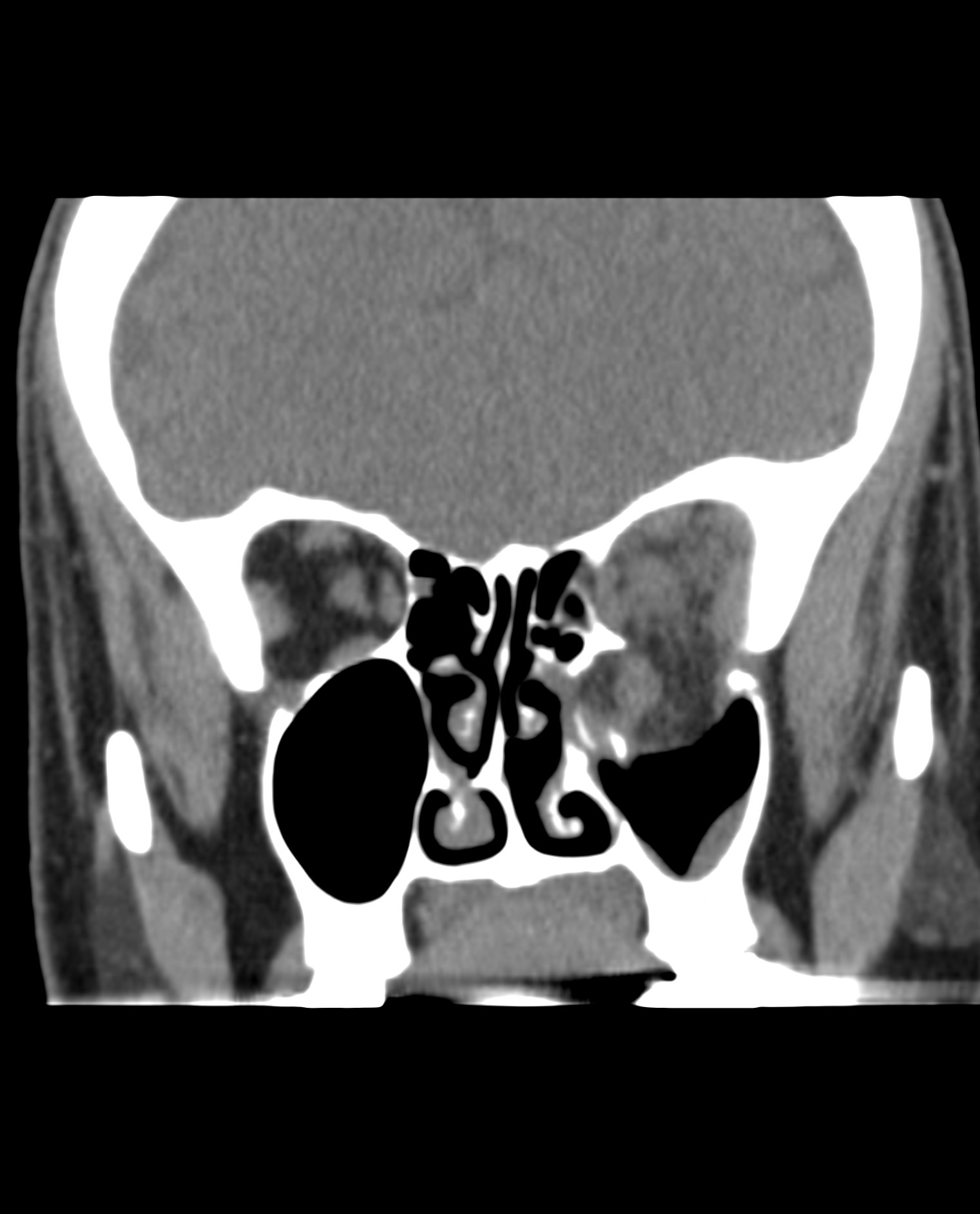 CT Weichteilfenster