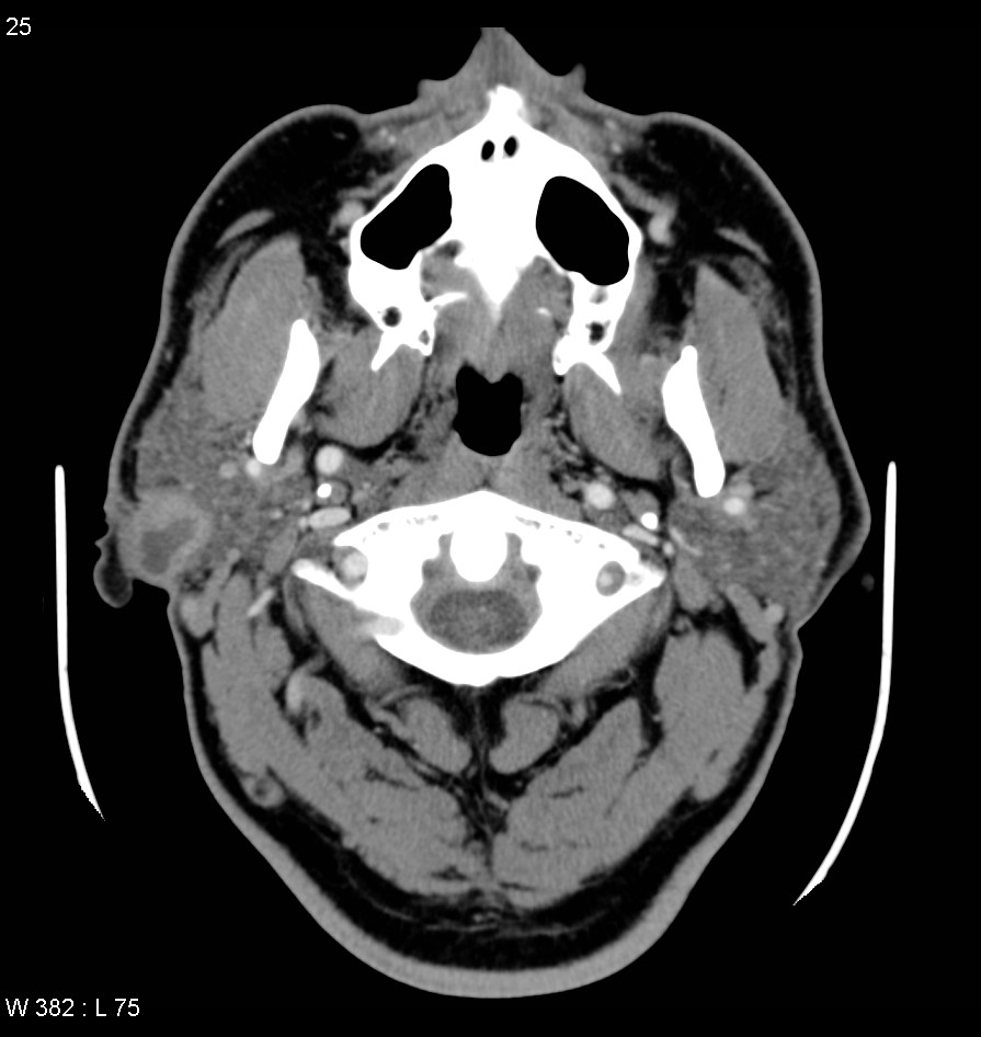 CT axial mit Kontrastmittel