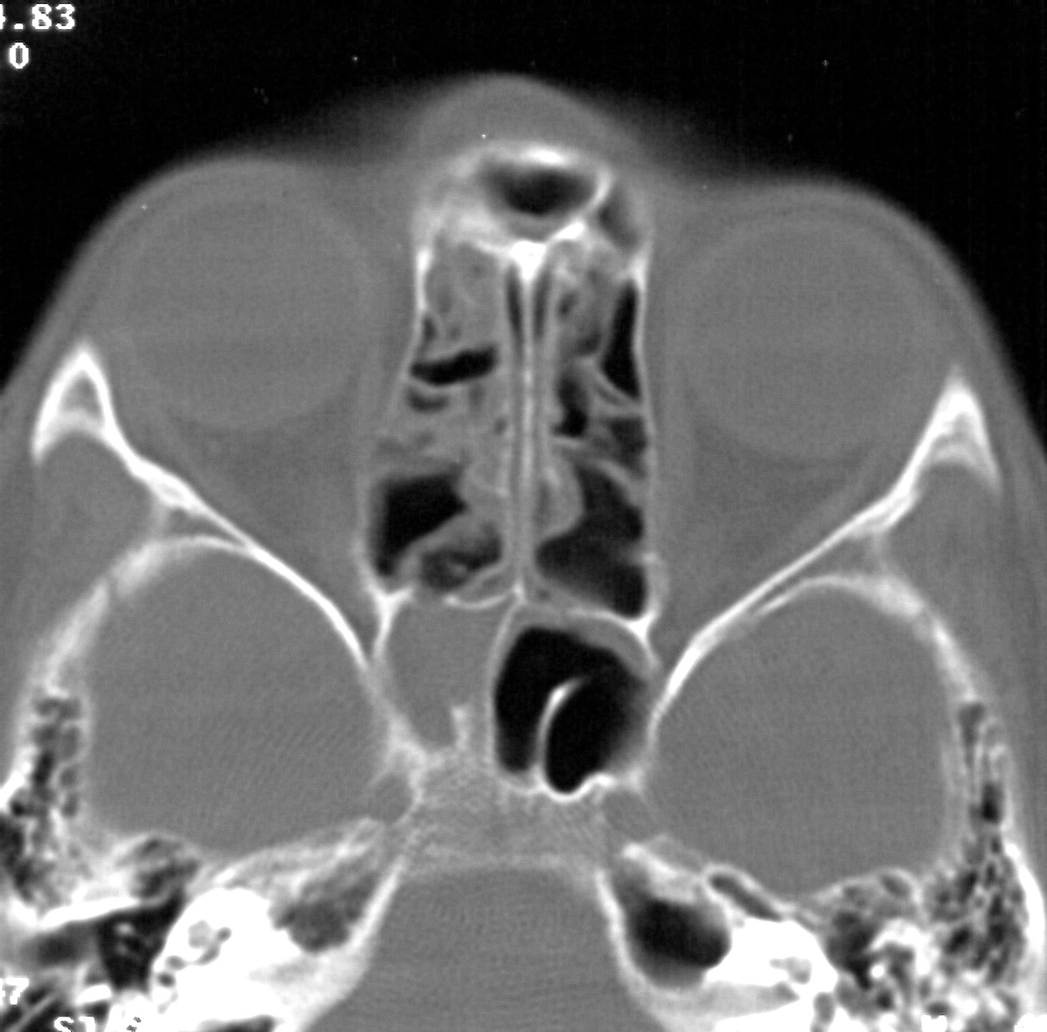 axiales CT Knochenfenster