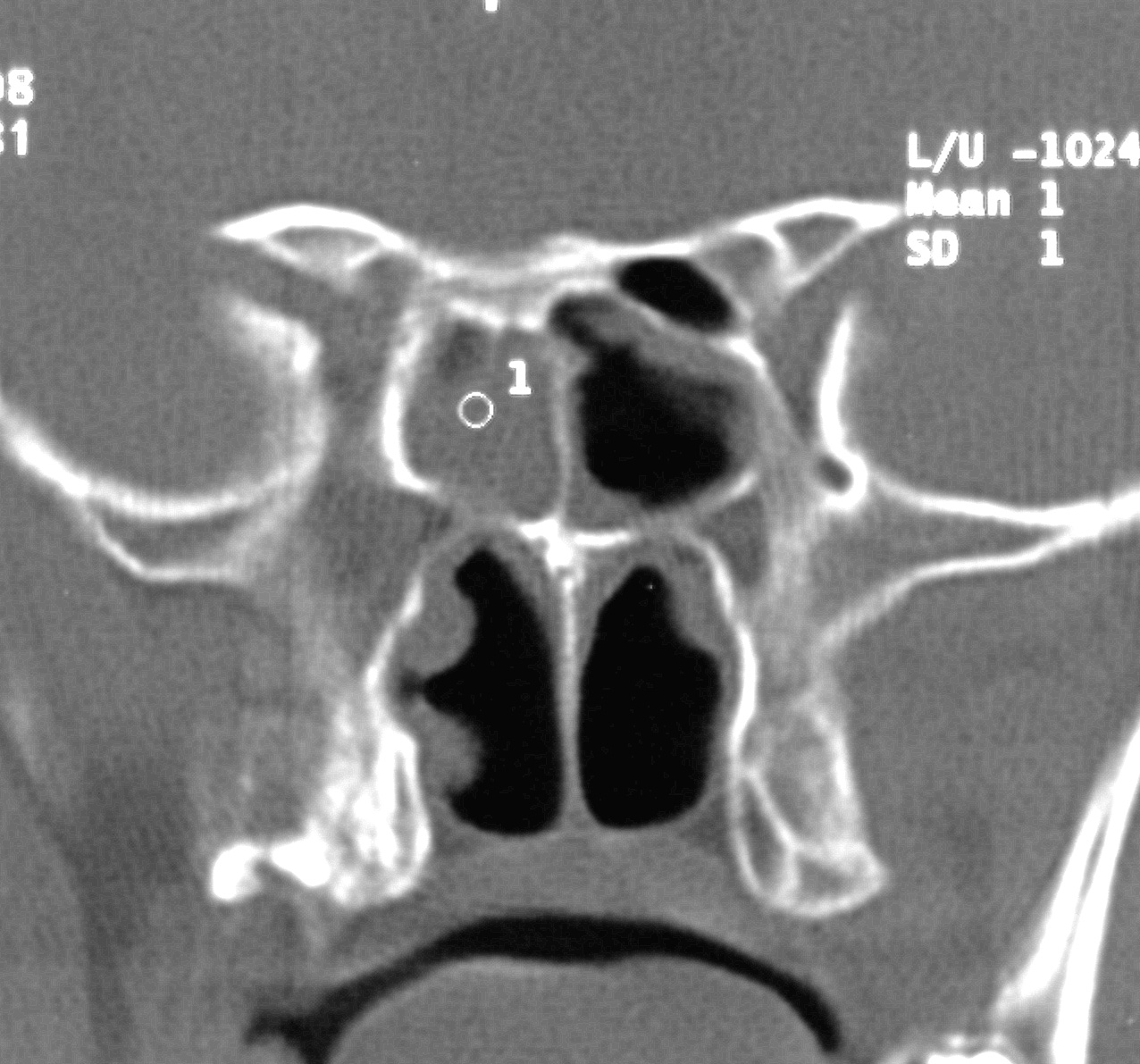 Coronar CT Knochenfenster