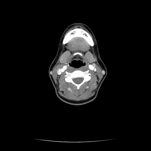CT Hals axial mit Kontrastmittel