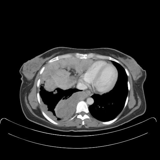 CT Weichteilfenster axial