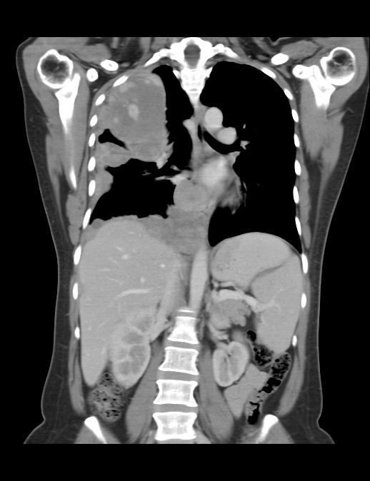 CT Weichteilfenster koronar