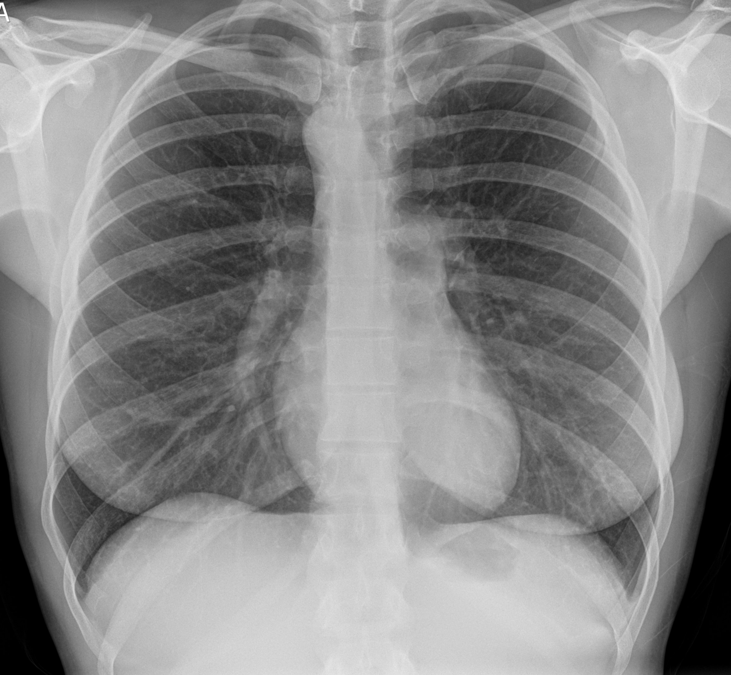 Röntgen-Thorax im Stehen in 1 Ebene