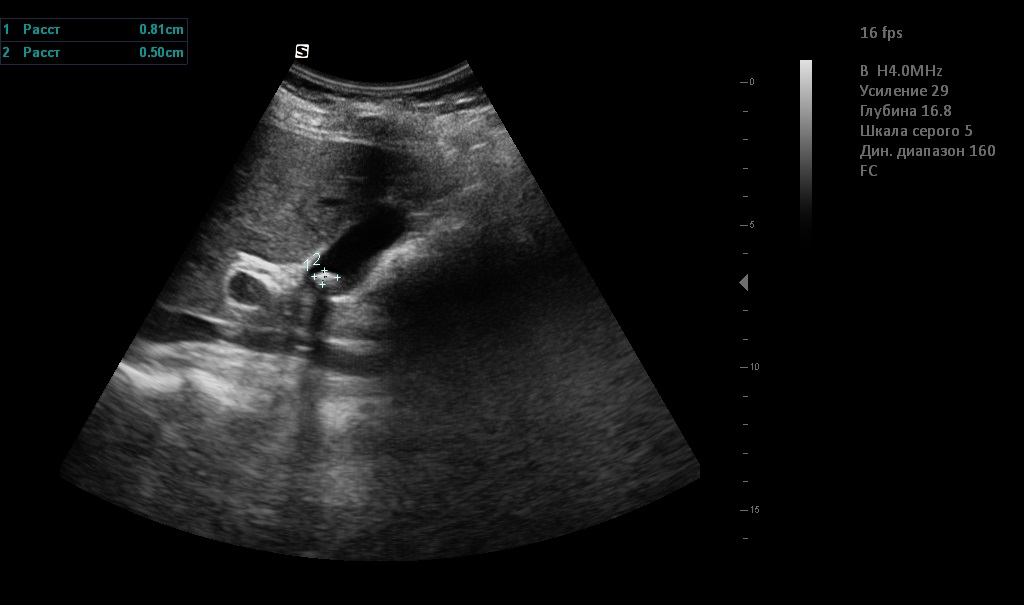 Ultraschall Leberregion