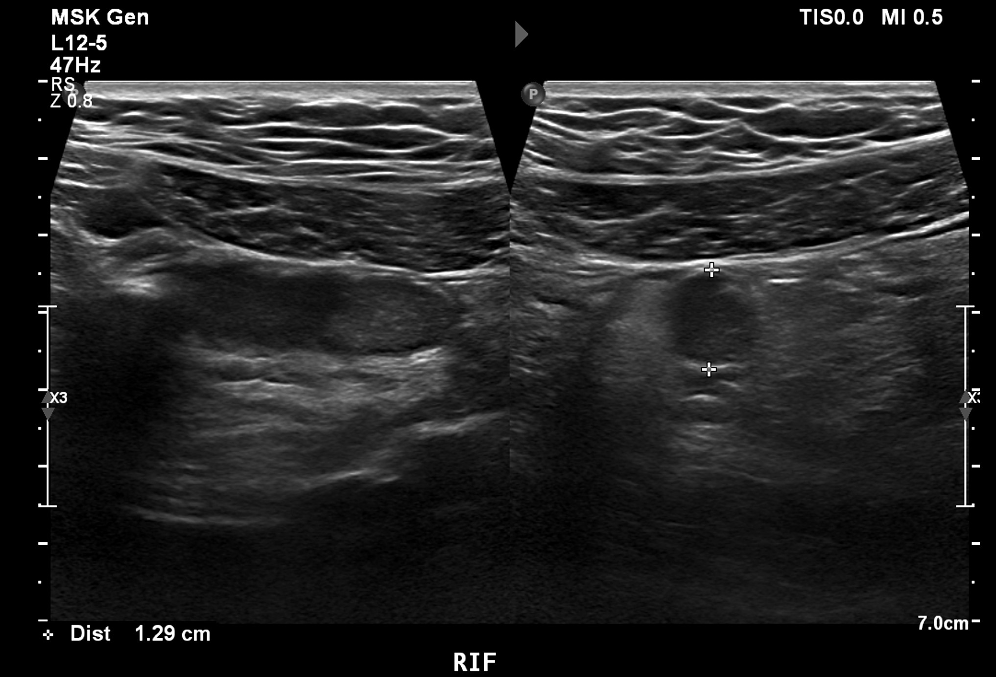 Ultraschall re. Unterbauch