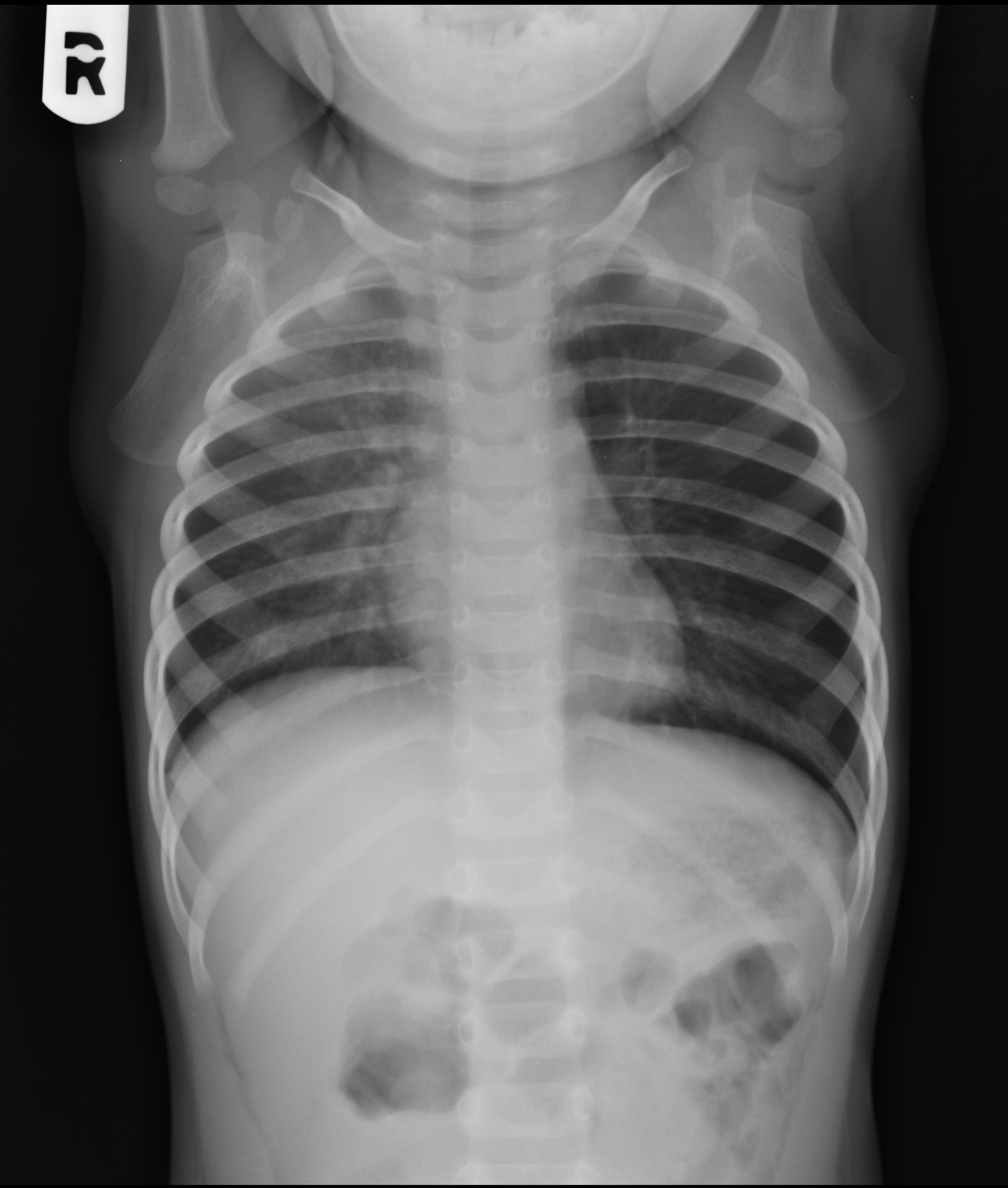 Röntgen Thorax a.p.