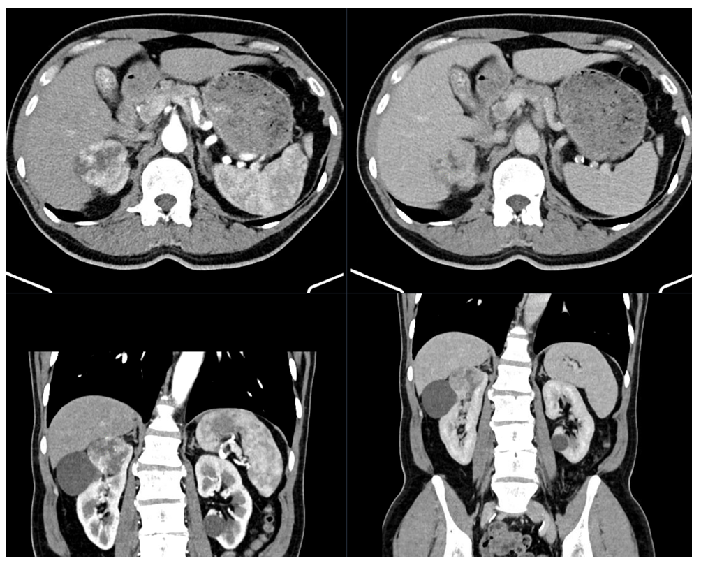 CT Abdomen