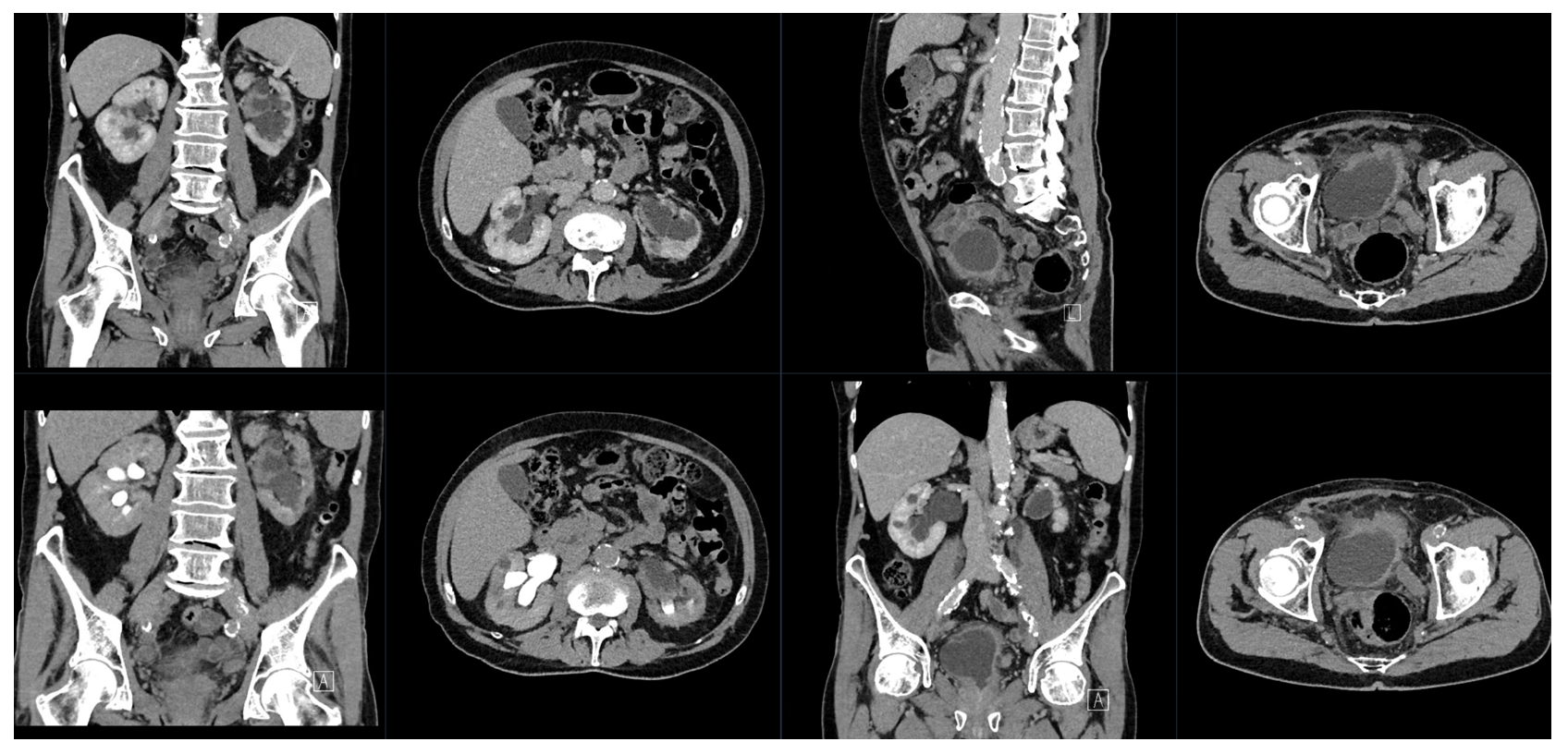 CT axial, coronar, sagittal WT, portalvenös + Urospät