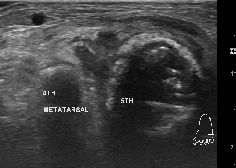 Ultraschall Fuß Metatarsal 5.