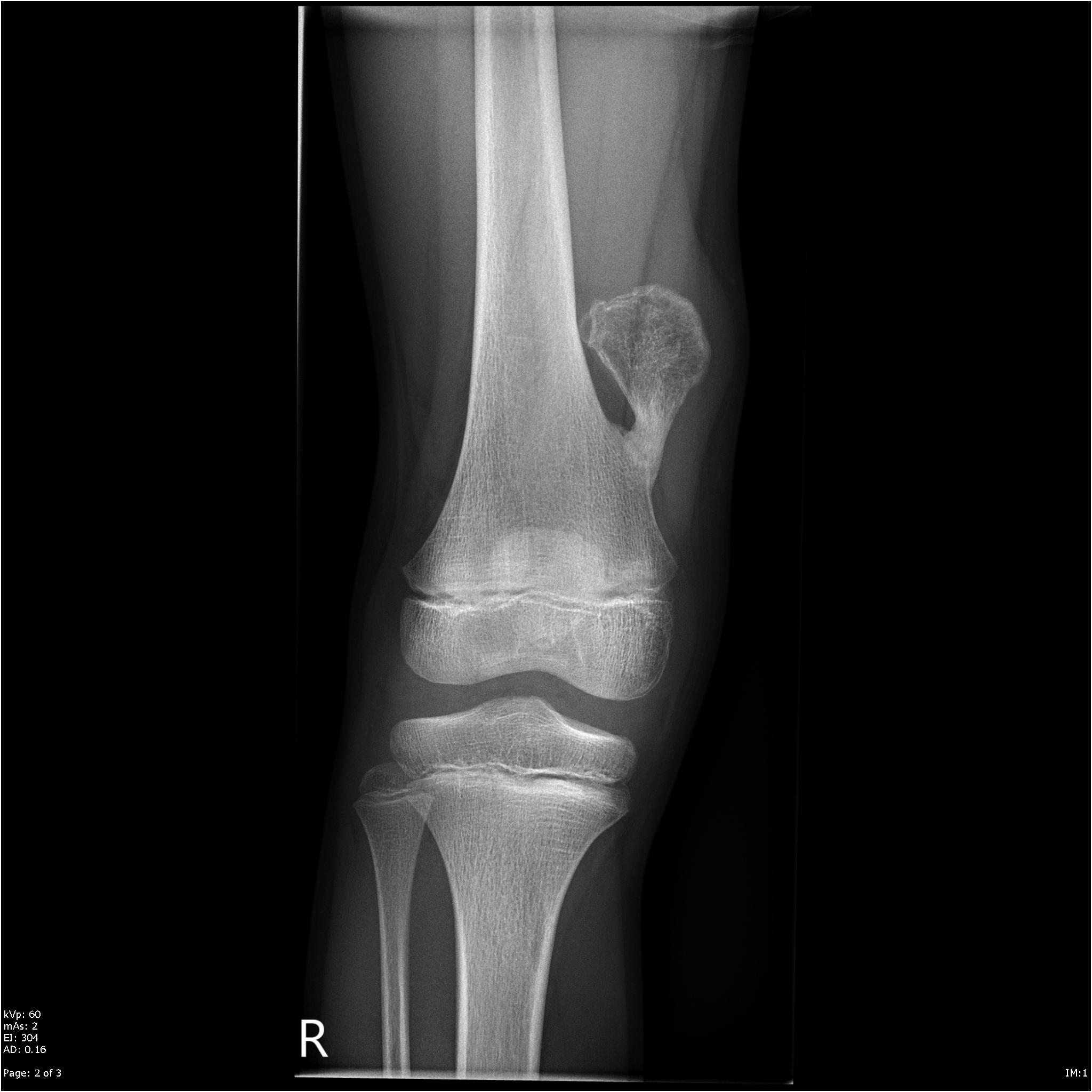 Röntgen Knie a.p.