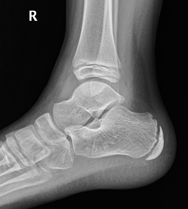 Röntgen OSG lateral