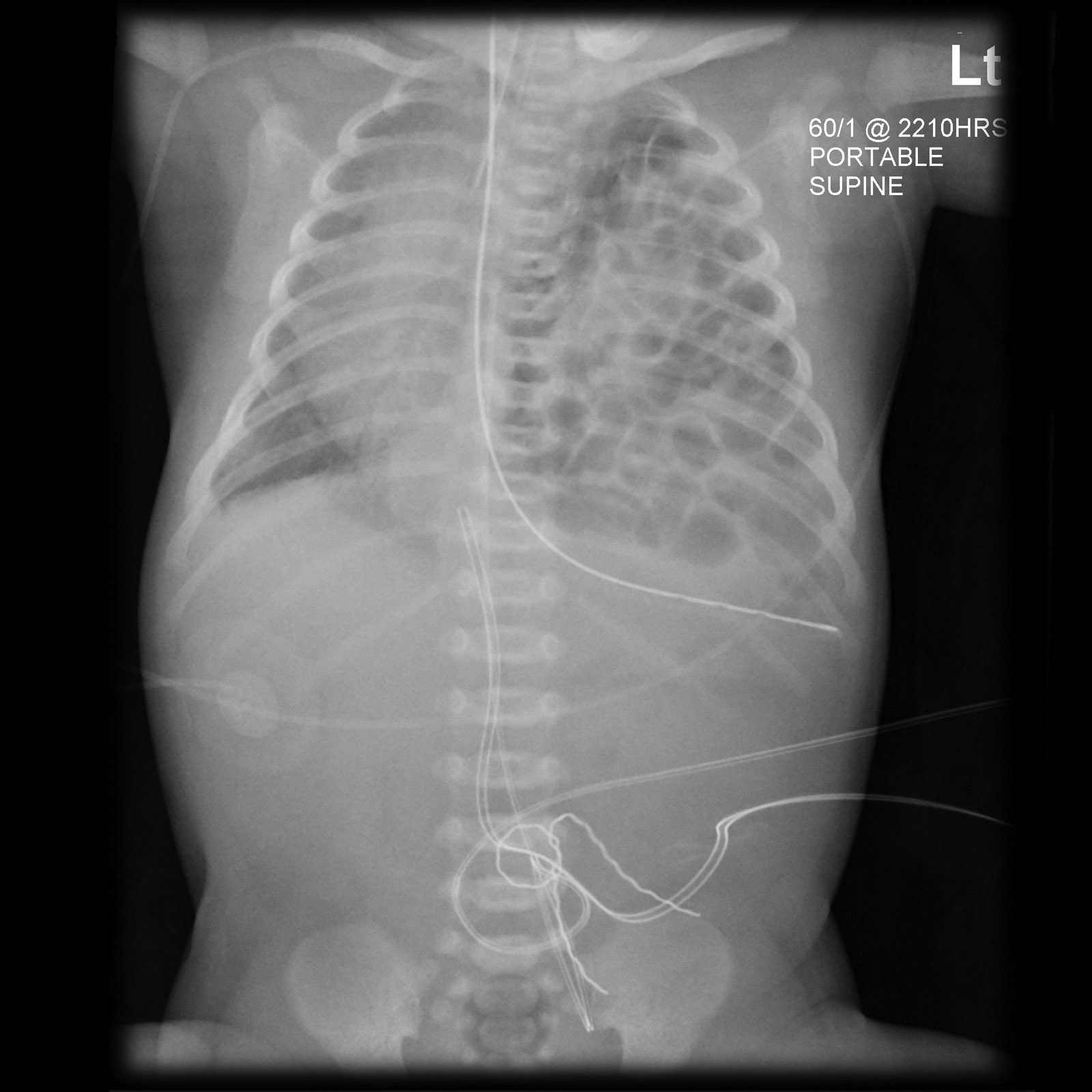 Röntgen Abdomen a.p.