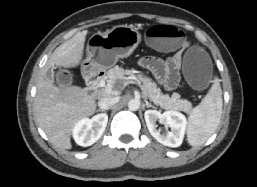 Kontrastmittelgestütztes axiales CT-Bild