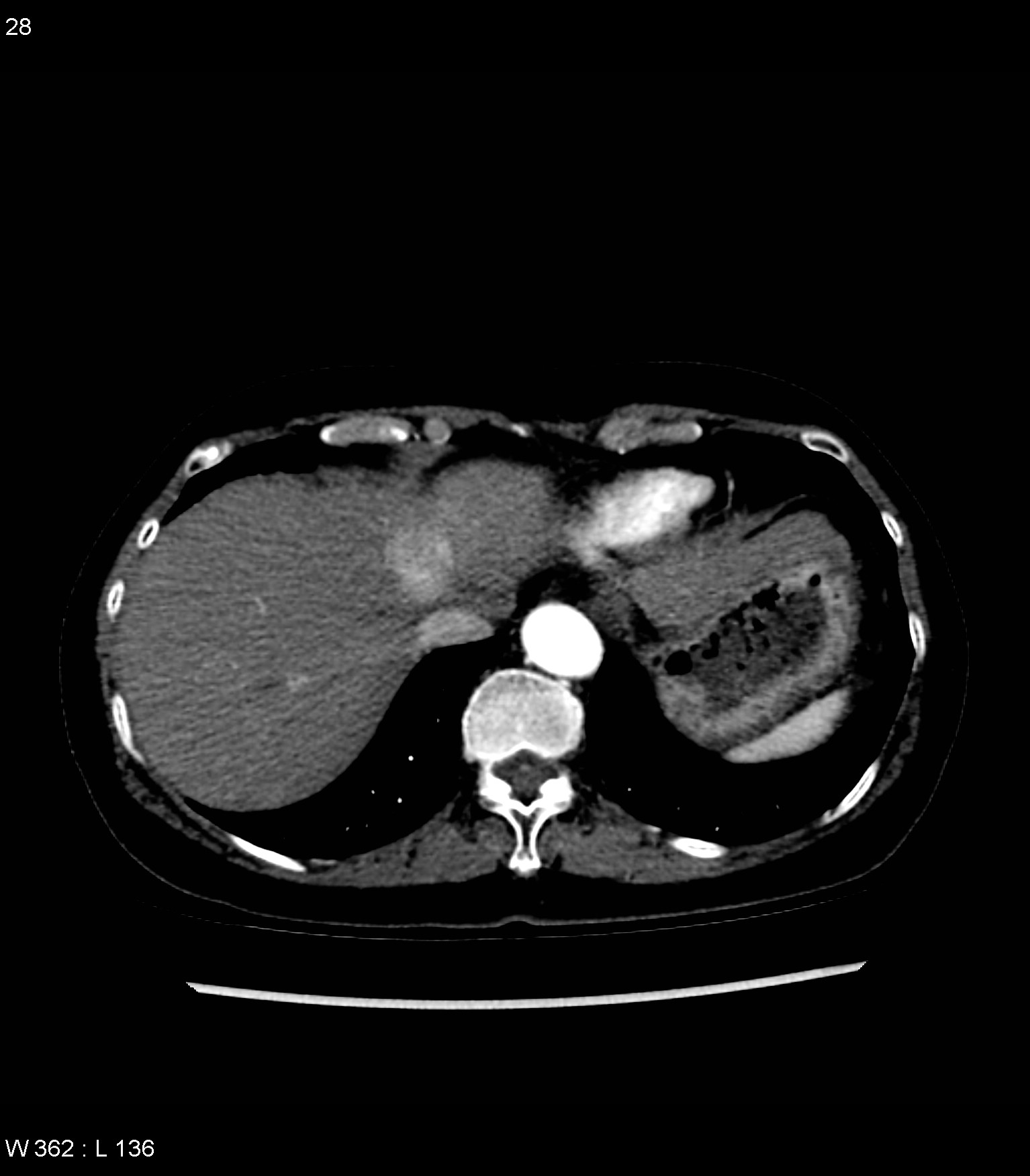 CT transversal arterielle Phase