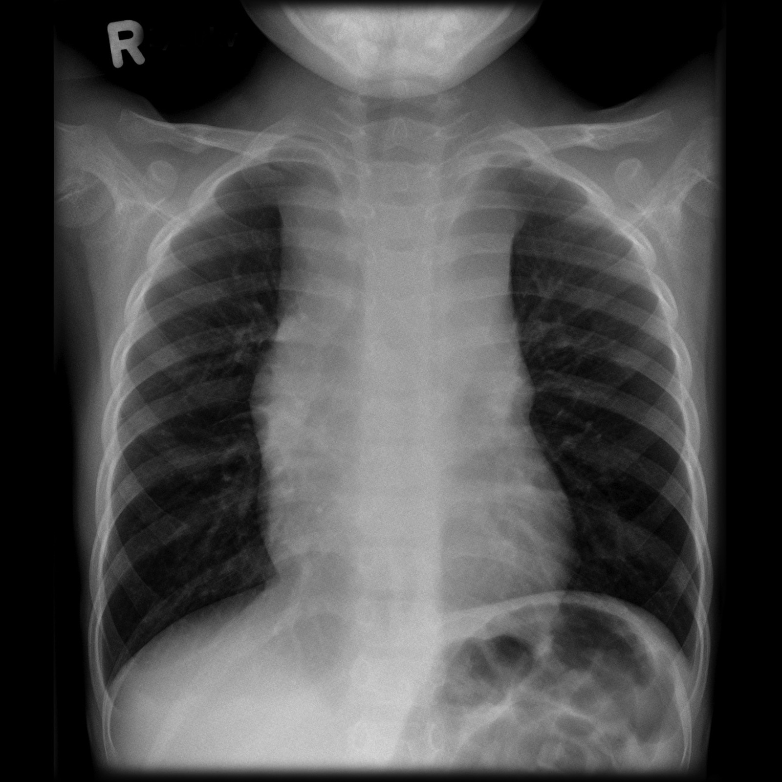 Anterior X-Ray.