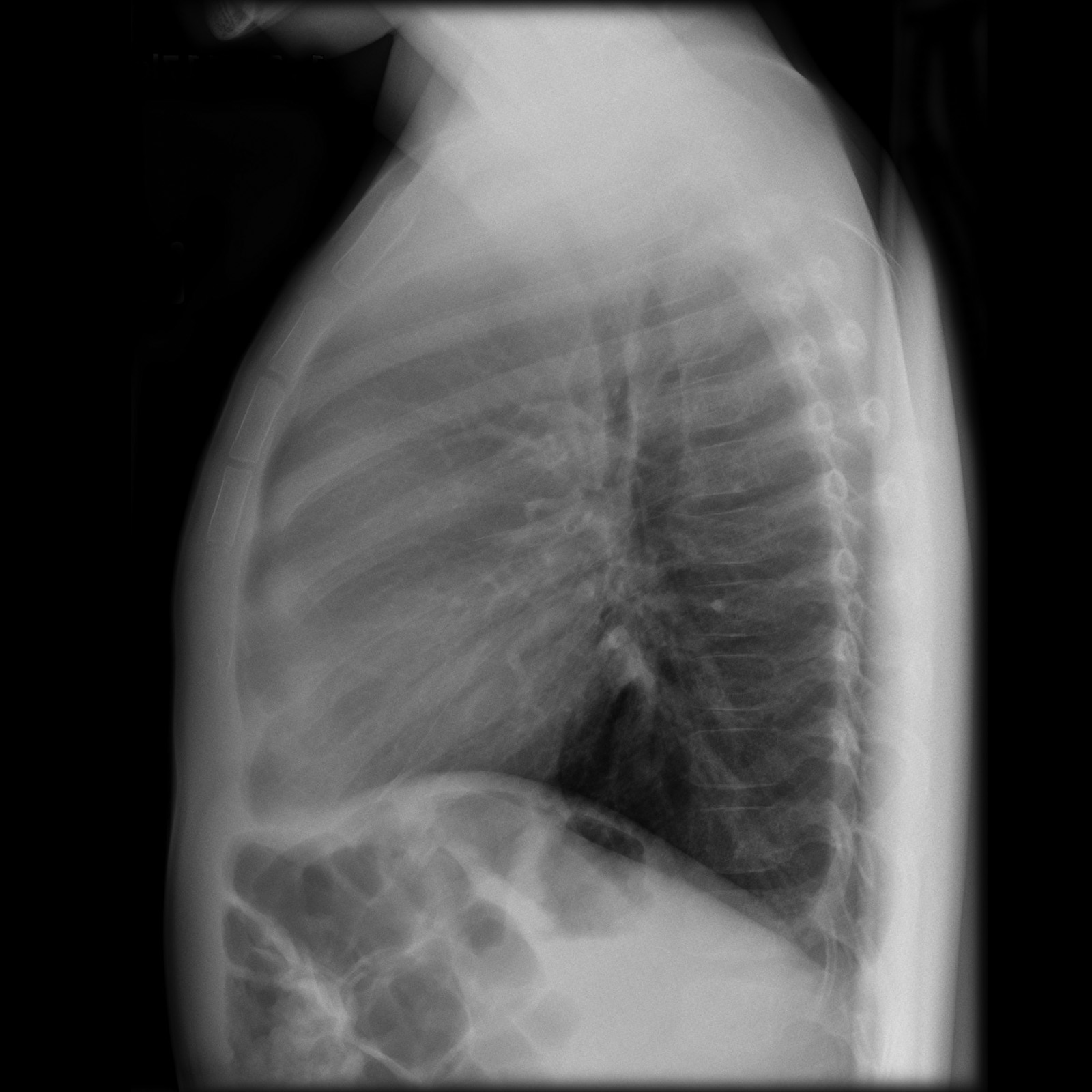 Lateral X-Ray.