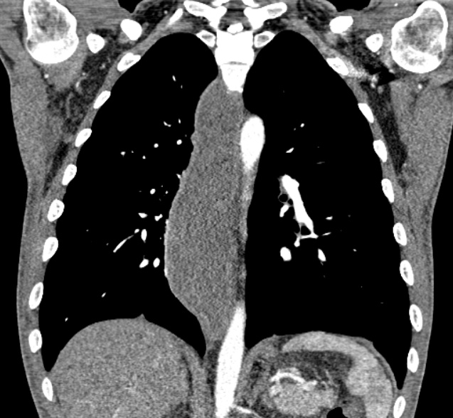 CT coronar mit Kontrastmittel