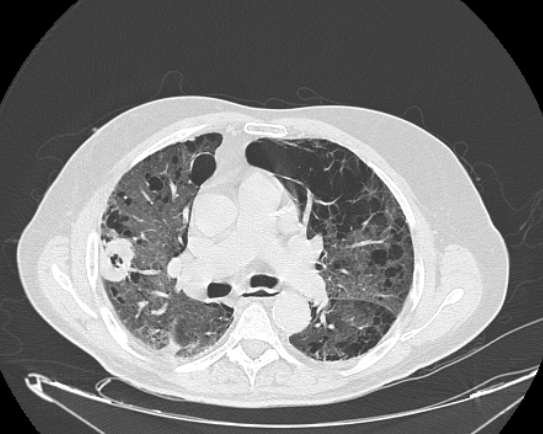 CT Thorax axial