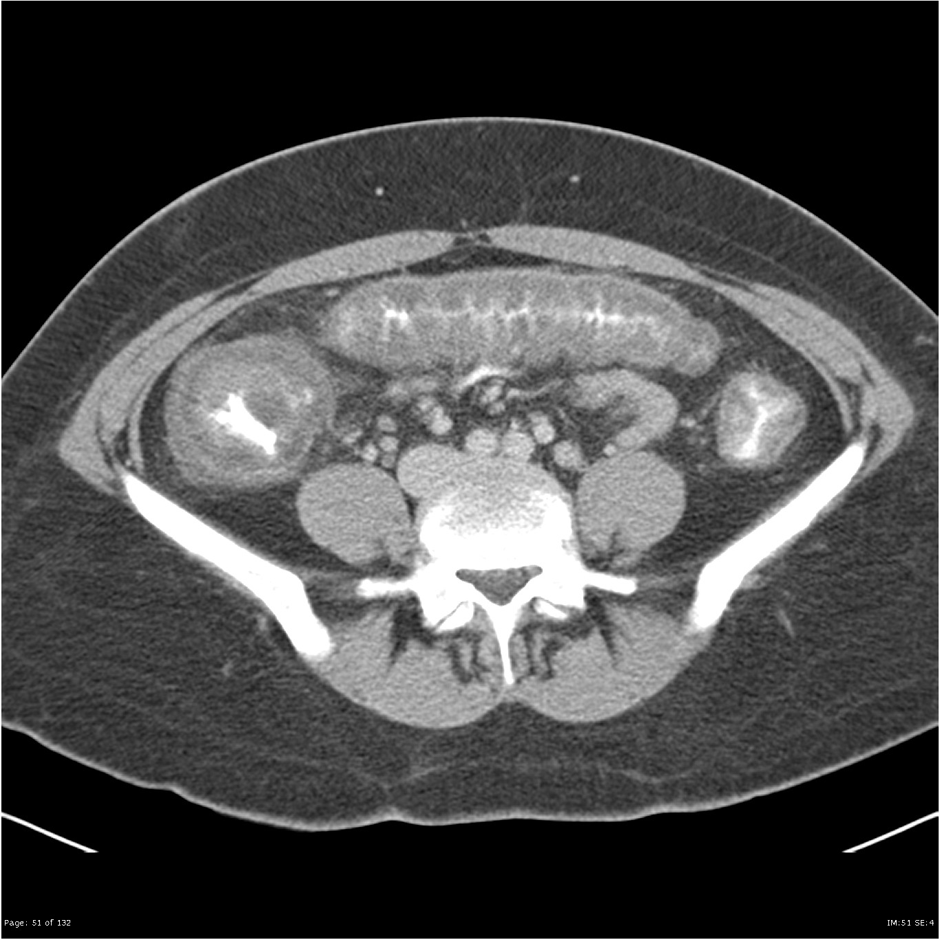 CT Abdomen transversal venös plus oral KM