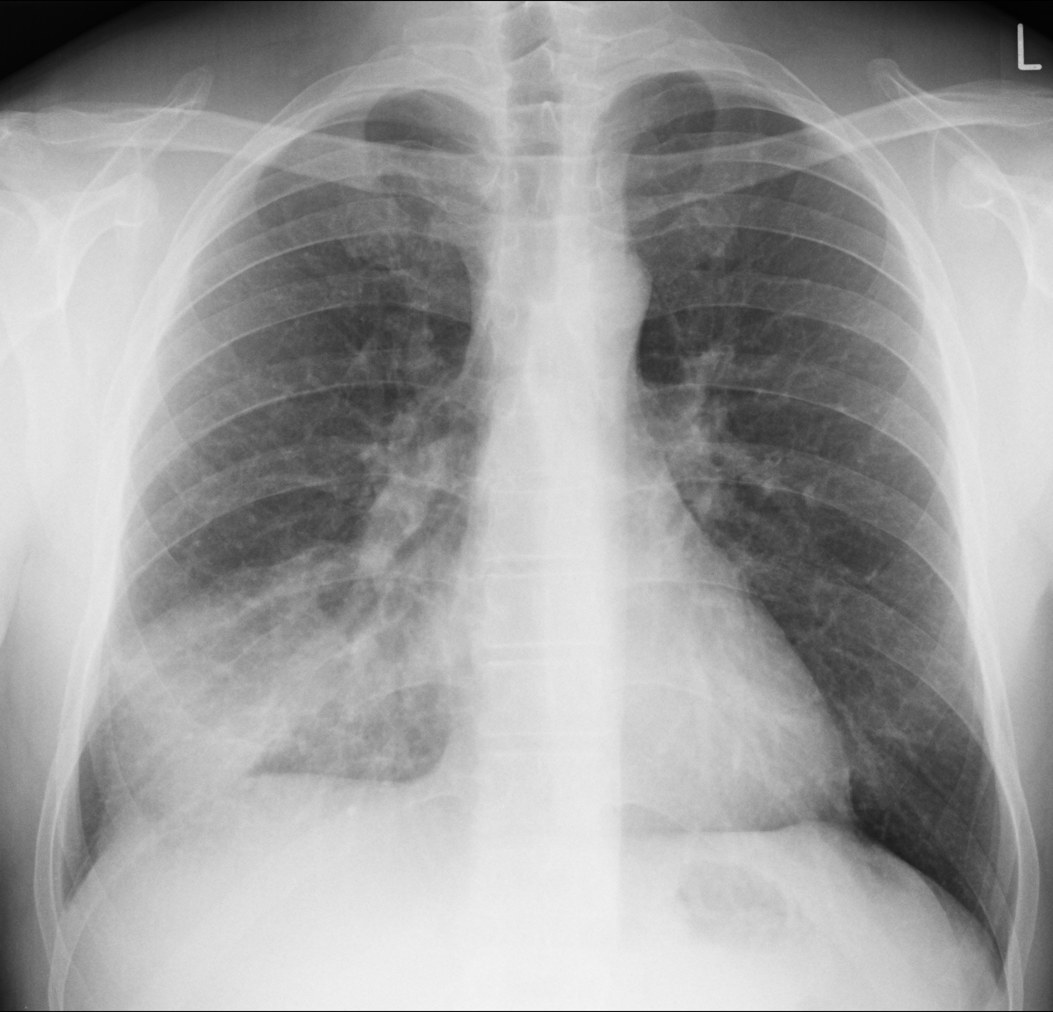 Projektionsradiographie des Thorax 