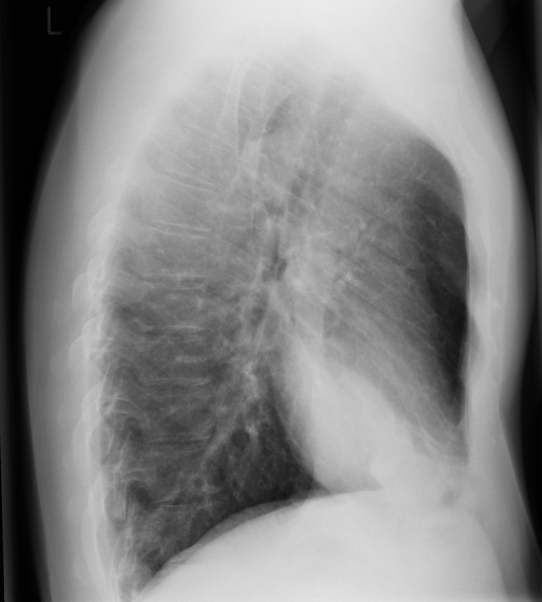 Röntgen Thorax lateral