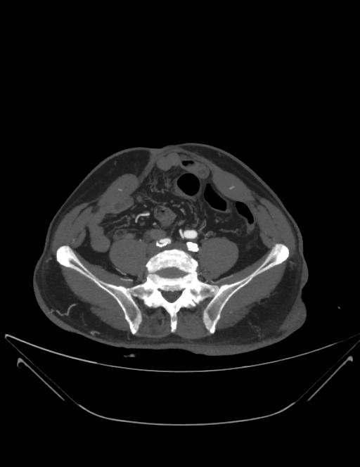 CT-Angiographie