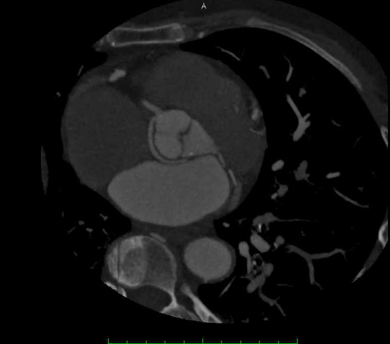Kardiale CT-Angiographie