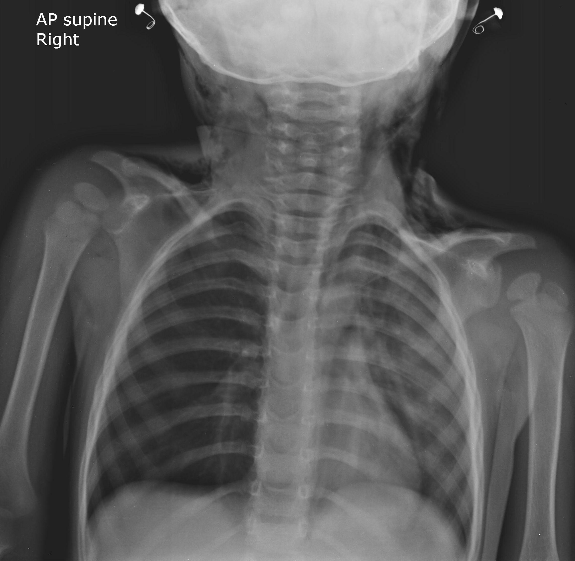 Röntgen Thorax 