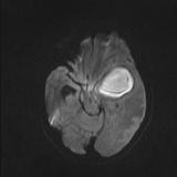 DWI axial