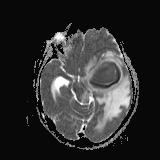 ADC axial