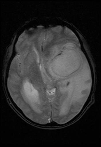 SWI axial