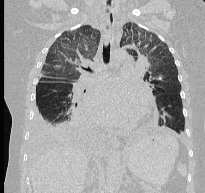 Coronares CT.