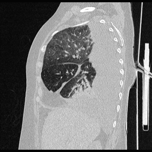Sagittales CT
