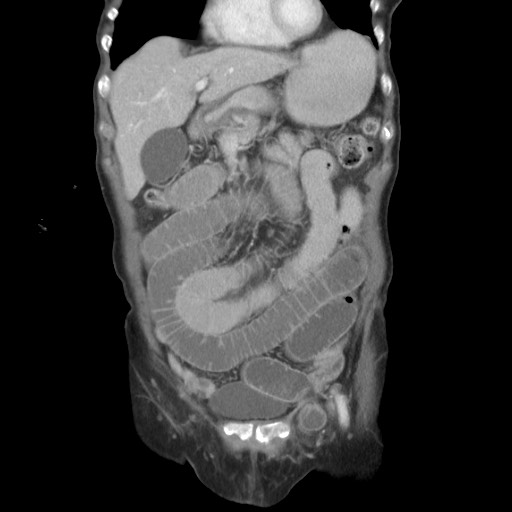 CT Abdomen coronar portalvenöse Phase
