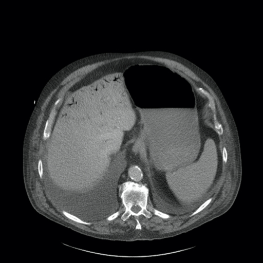 CT Abdomen trasnversal portalvenöse Phase