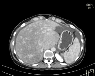 CT Abdomen transversal portalvenöse Phase