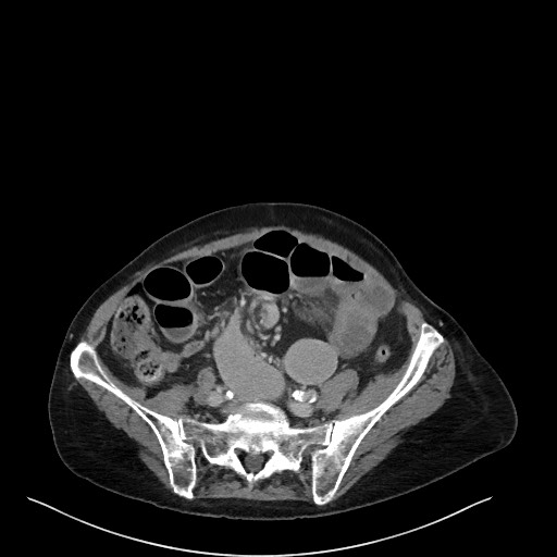 CT Abdomen venös transversal